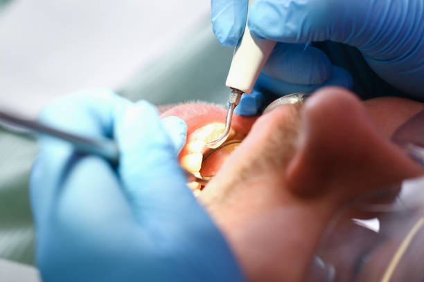 Best Urgent Care for Lost Fillings or Crowns in Radford, VA